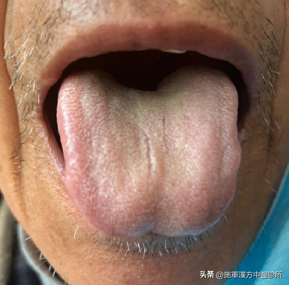 面红发热痒中医经方治疗,手背发热中医经方