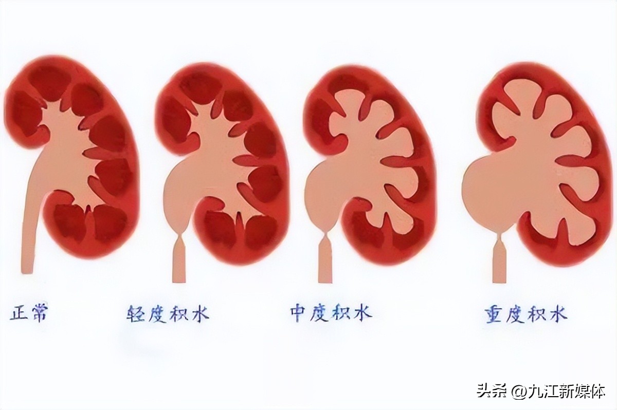 婴儿左肾重度积水怎么办,刚出生的婴儿肾积水22mm