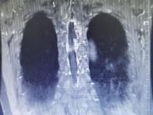 八旬老人瘫痪在床，微创手术重获新生——秦皇岛北医三院神经外科派驻专家为秦皇岛高危患者切除胸椎管肿瘤