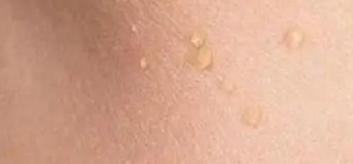 脖子和腋窝下的小肉粒怎么去除,脖子和腋下的小肉粒是啥