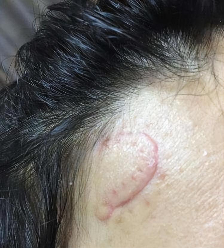 去鼻子上的黑头最好的方法,去鼻子上黑头的有效方法