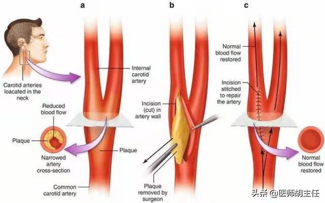 年轻人斑块是否能逆转,55岁大叔斑块消失