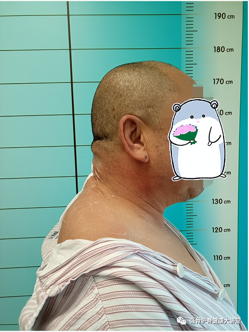 「医学科普」讨嫌的富贵包怎样形成的？怎么治疗？