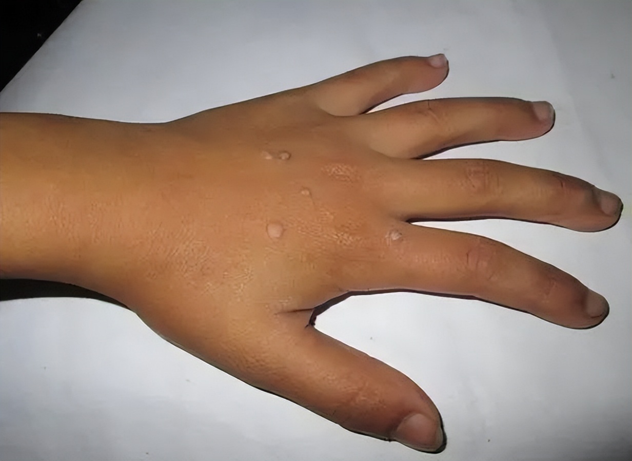 脖子上长小肉粒说明身体出了问题,脖子上的小肉粒说明身体有病