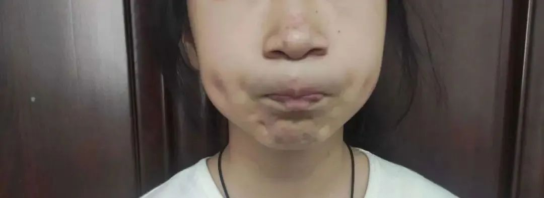 孩子嘴巴张不开发音小,小孩声带发育异常导致说话不清楚