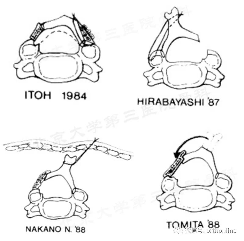 脊髓型颈椎病椎板成形术,椎间盘成形术指征