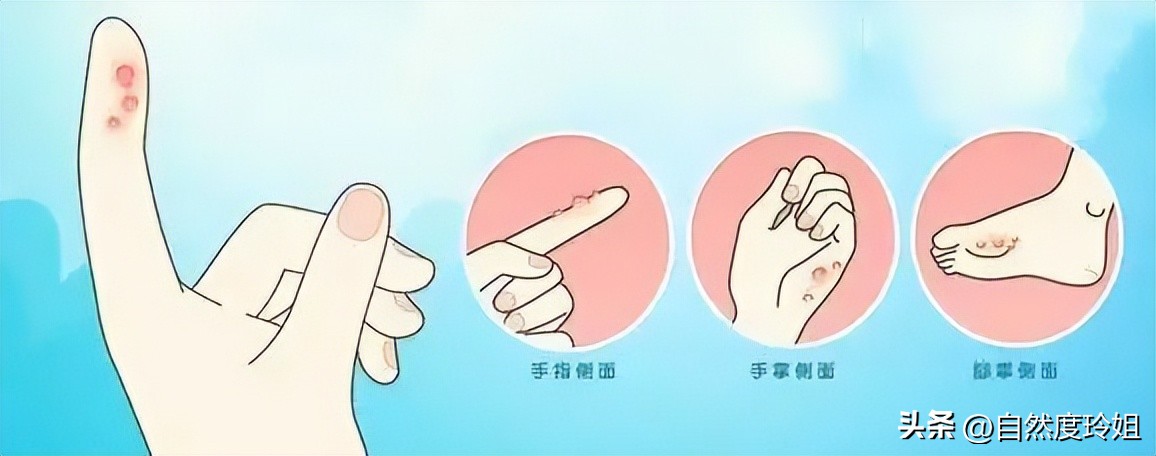 到夏天手脚就长小水泡能治愈吗,每到夏天手脚起小水泡不痒怎么办