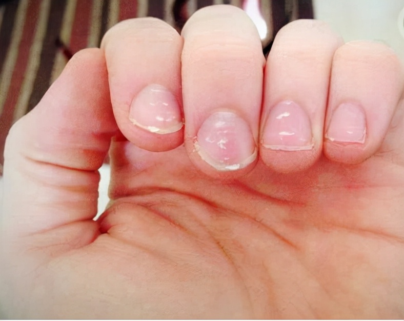 指甲有白点代表是缺钙还是缺锌,孩子指甲有白斑是缺钙吗