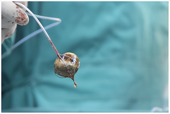 胆囊有结石建议摘除还是保胆取石,胆囊结石需要查肝功能吗