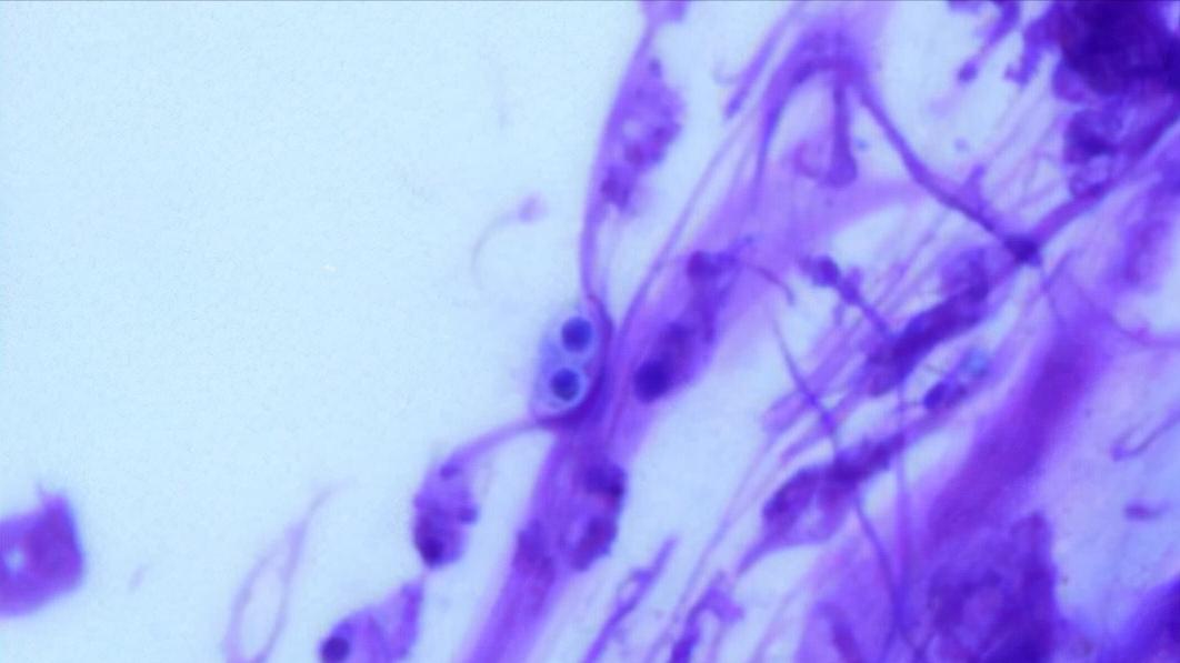 指甲往肉里长怎么办,指甲老往肉里钻