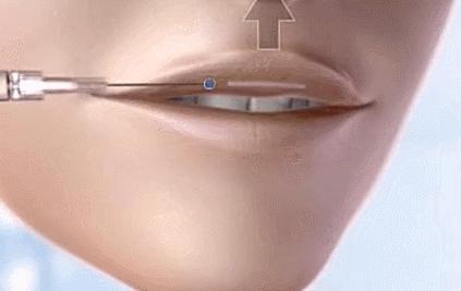 嘴唇薄变丰满,嘴唇变凸变丑怎么办