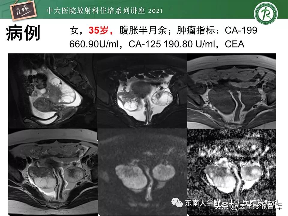 卵巢浆液性肿瘤的肉眼及镜下特征,卵巢原发性粘液性囊腺瘤