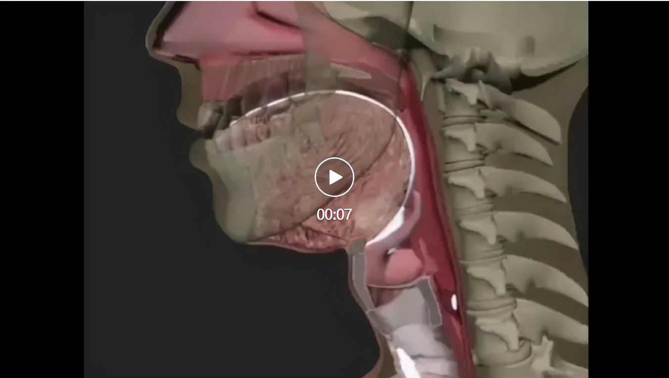 吞咽功能障碍康复模拟,吞咽功能障碍咽反射康复训练