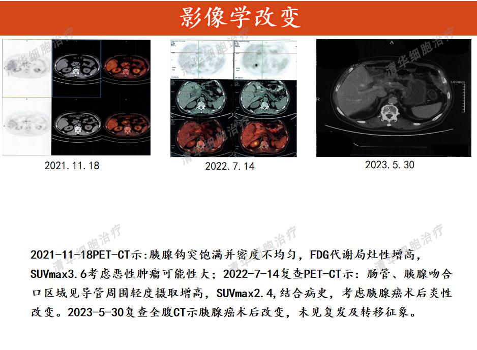 胰腺癌复发率高、预后差，联合细胞治疗提升生存期