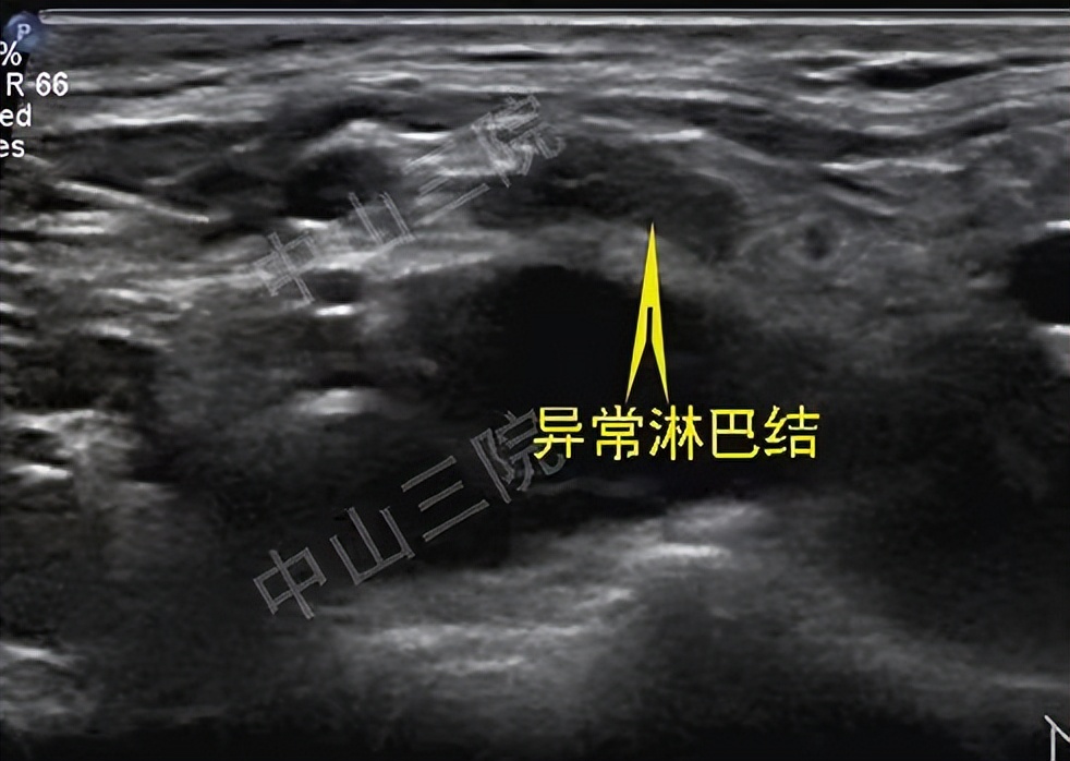 甲状腺癌做过碘131治疗还能活多久,甲状腺癌做碘131后变甲减了怎么办