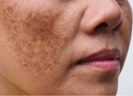 脸上长小斑点怎么去除,手背上长斑点怎么去除