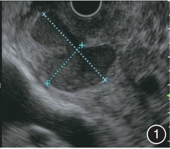 超声内镜诊治合并假性囊肿的沟槽状胰腺炎1例