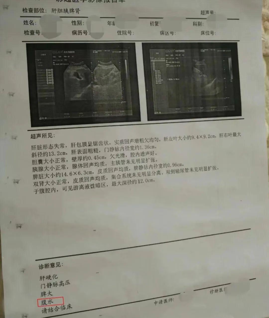 67岁奶奶被抢救,奶奶突发脑溢血抢救无效死亡