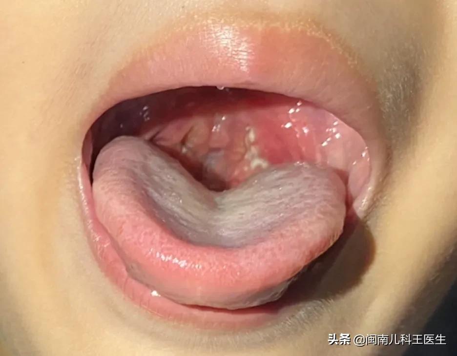 儿童扁桃体三度肿大会有什么影响,扁桃体发炎单核细胞高怎么办