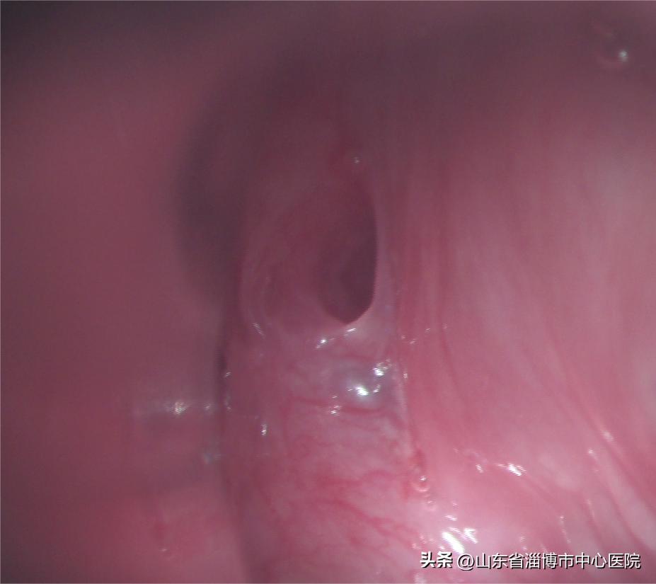 咽喉微创手术县级医院能否做,咽喉部的微创手术