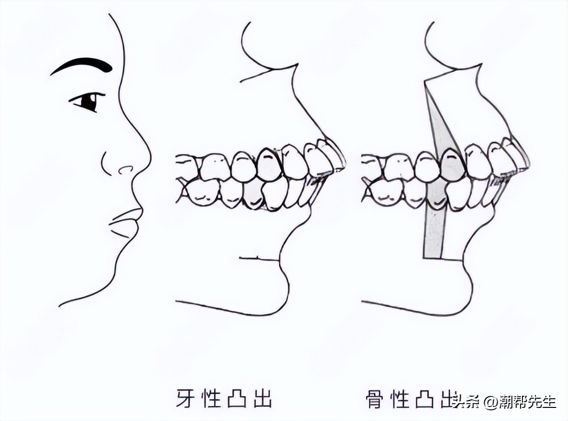 如何辨别唇性嘴凸和齿性嘴凸,嘴凸和嘴龅的区别