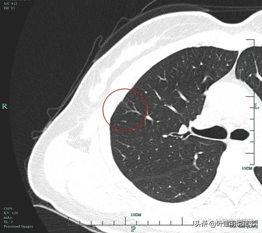 磨玻璃结节伴有增生是癌症吗,磨玻璃结节会是别的癌转移的吗