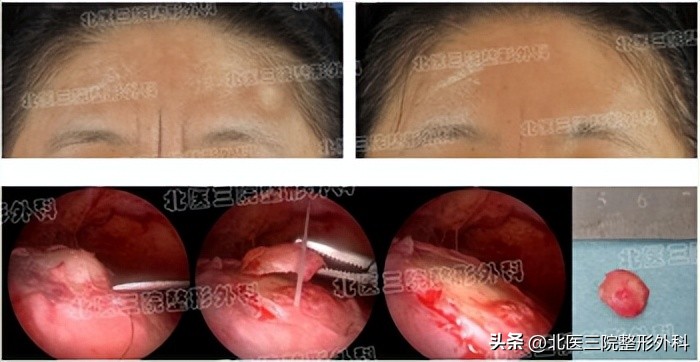 额头上长了个硬疙瘩很疼怎么办,额头上长了一个硬疙瘩是怎么回事