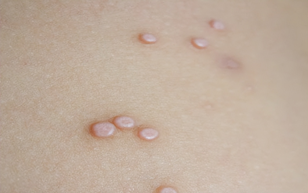 腋下有小肉粒是hpv感染会怎么样,腋下长小肉粒是hpv感染吗怎么治疗