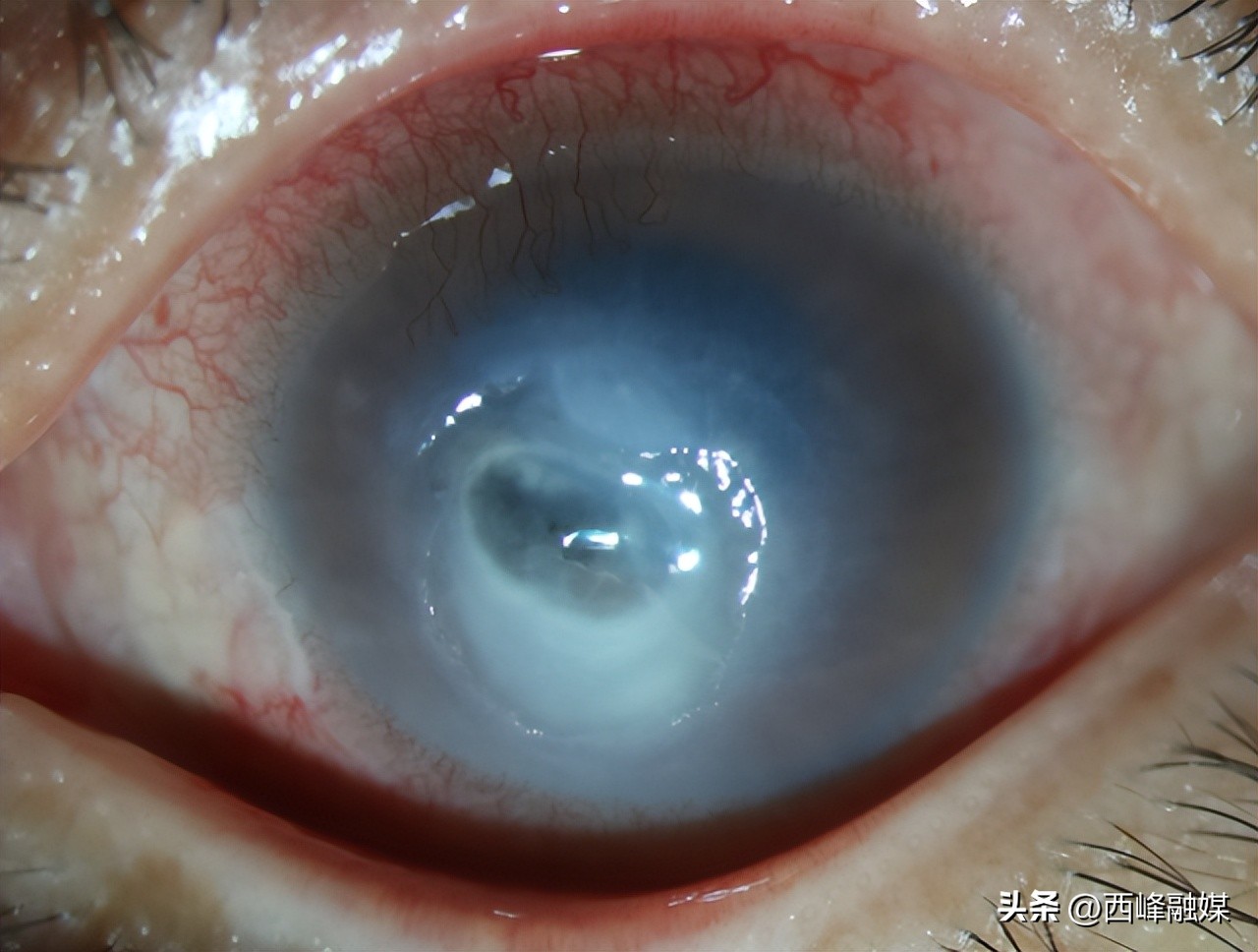 眼睛感染阳了症状,感染后眼睛疼怎么办