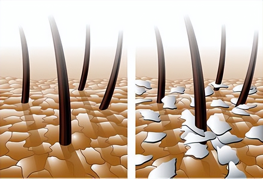 头皮长疙瘩脓包是什么原因,头皮长疙瘩或脓包有哪三种征兆