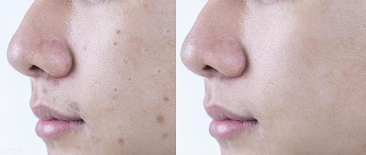 痘印痘疤不用药怎样才能消除更快,治疗痘痘痘印的最有效的药膏