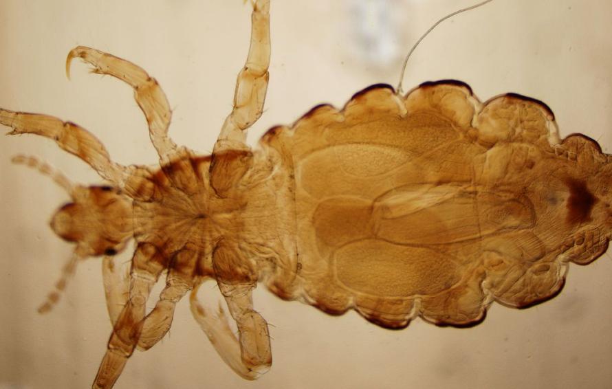 女子腹部痒，医生用镊子夹出16只阴虱！原来阴虱有4个传播途径