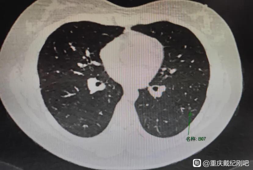 9mm恶性磨玻璃结节肺癌几期,磨玻璃结节8mm同家医院随访8年
