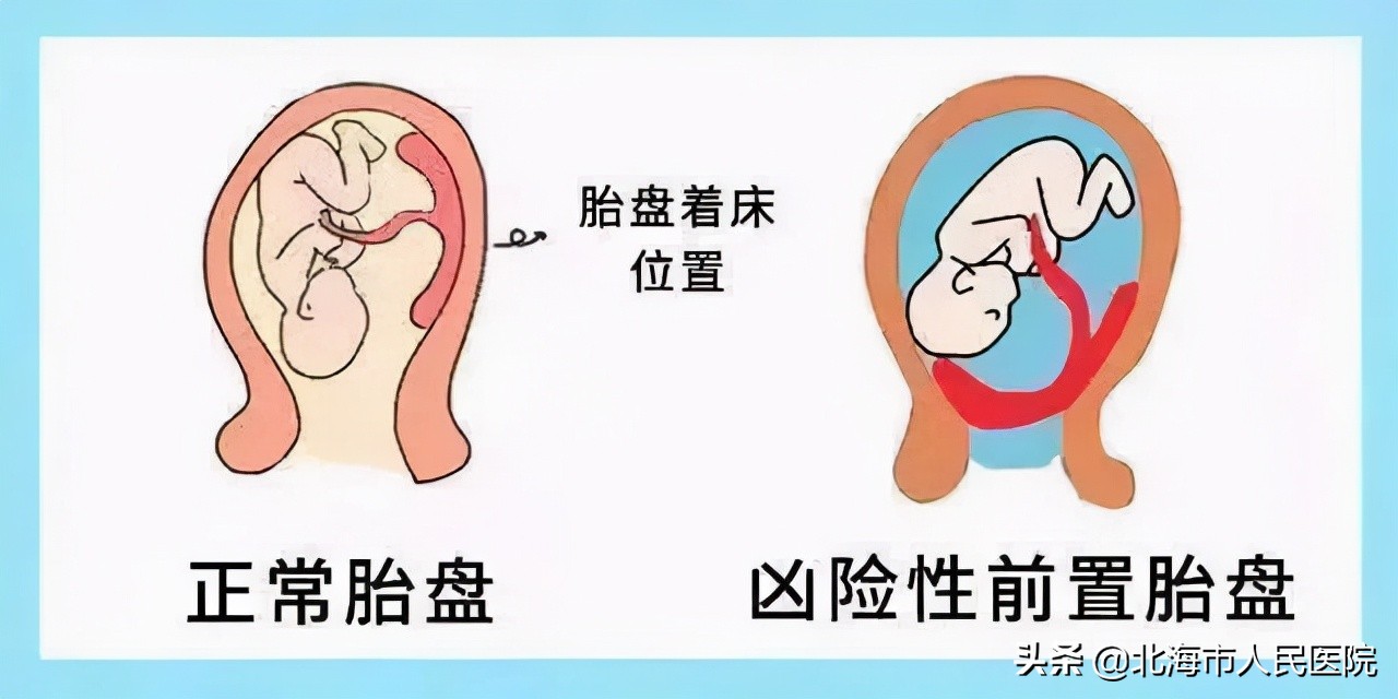 凶险性前置胎盘28周胎盘植入,凶险性胎盘前置35周