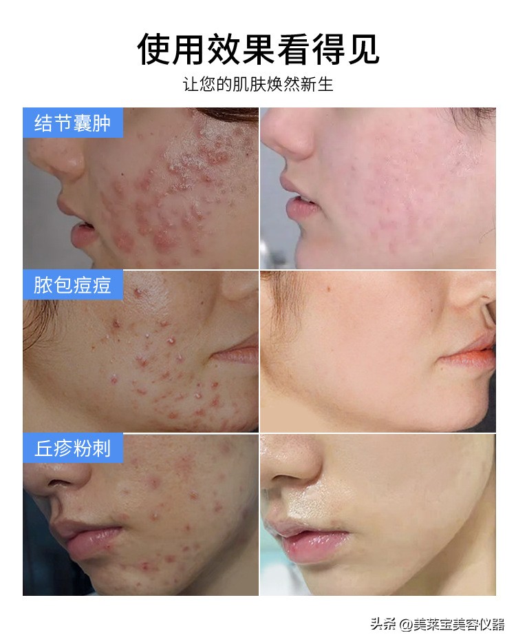 祛痘厂家代理贴牌,祛痘产品代加工贴牌