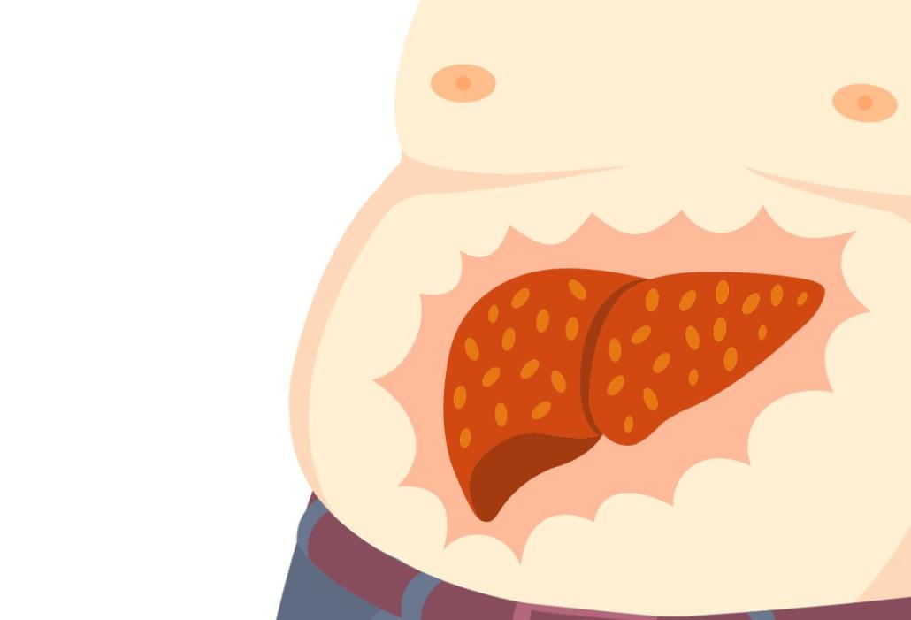 仲景治脂肪肝处方,仲景治疗脂肪肝的中成药