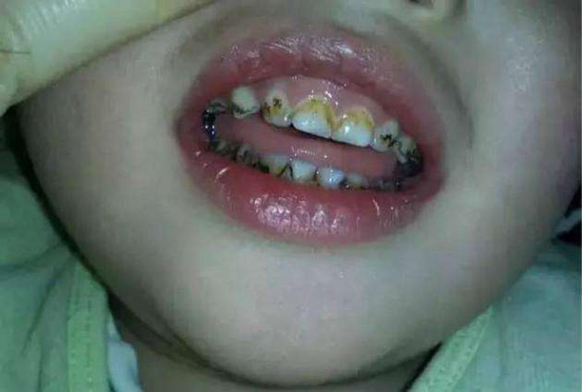 孩子满嘴小黑牙的原因,5岁小孩有小黑牙需要治疗吗