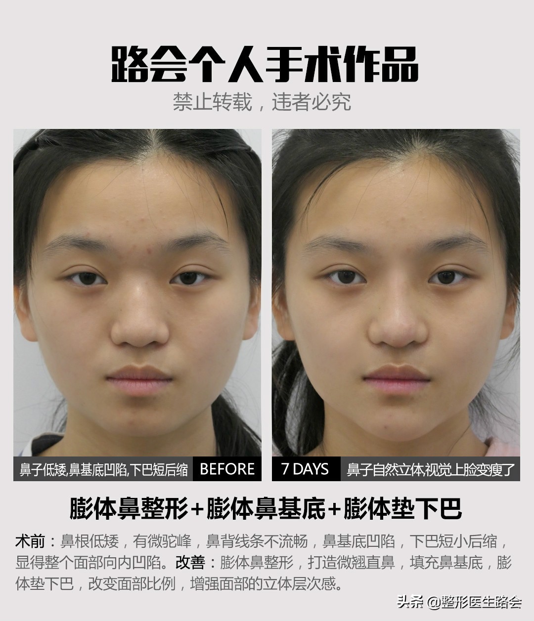 三甲医院鼻整形医生,鼻子整形医生科普类视频