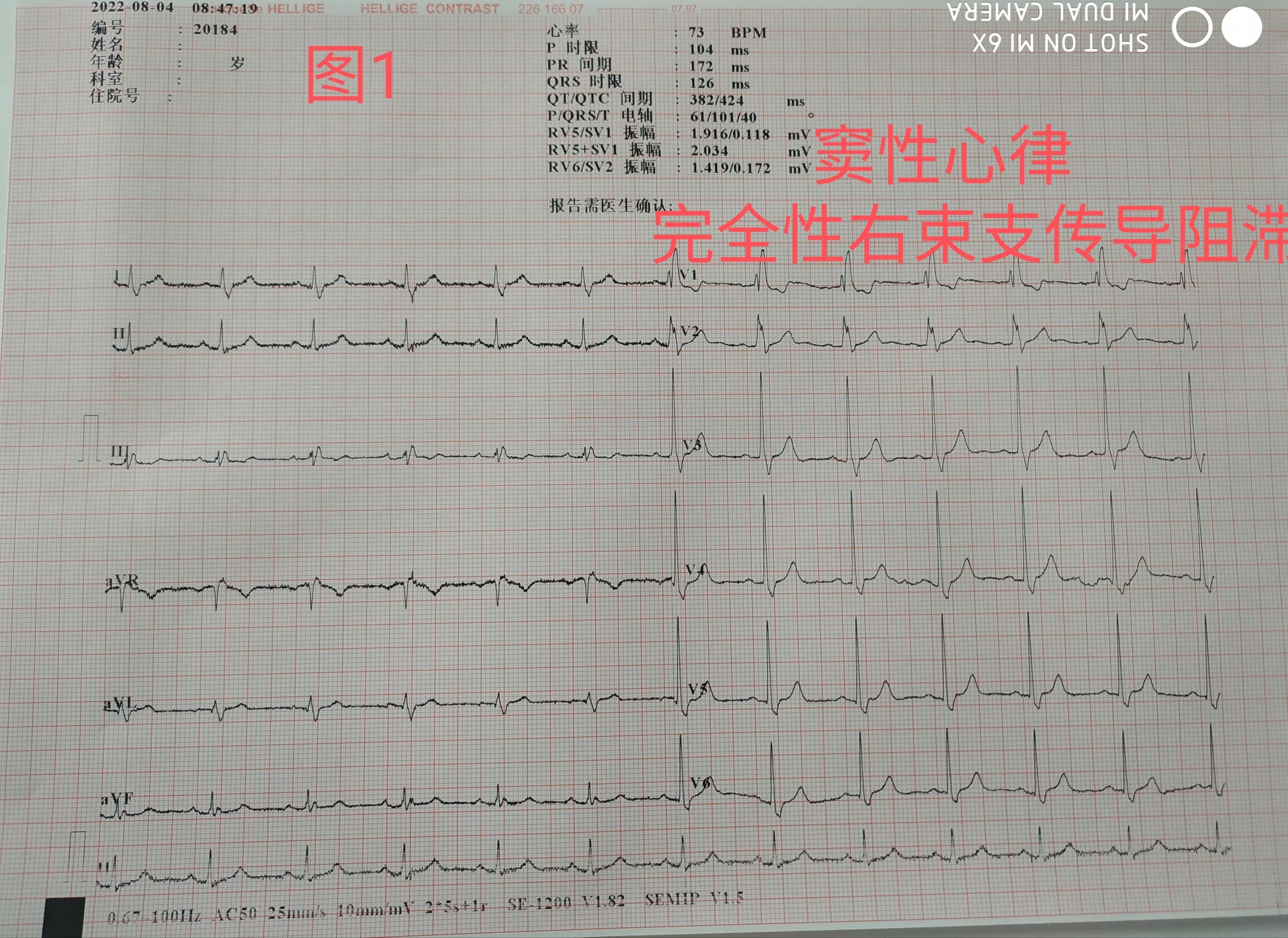 完全性右束支传导阻滞体检,完全性右束支传导阻滞