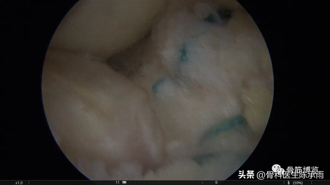内侧半月板前角囊肿,关节镜下内侧半月板部分切除术