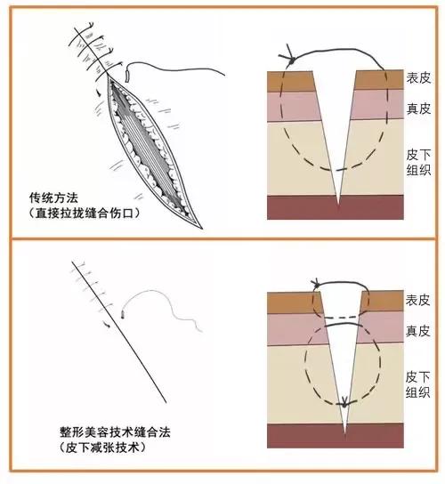伤口缝合留疤还是不缝合留疤,可吸收的缝合线有疤痕吗