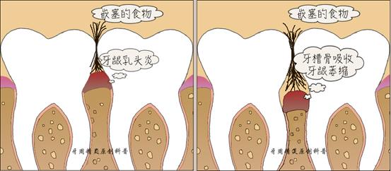 装固定假牙后牙痛怎么办要拆除吗,为什么做假牙就牙痛