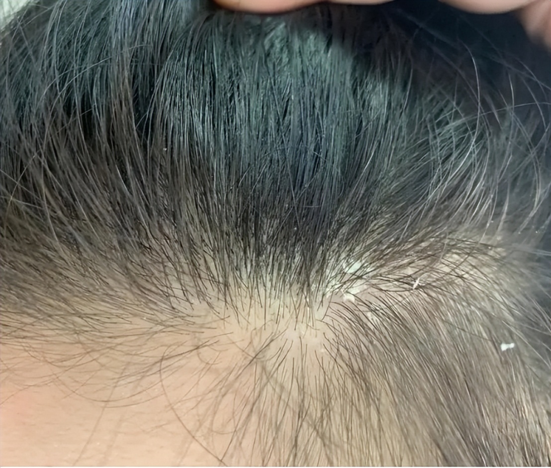 怎样治疗脱发掉头发最有效,掉头发怎么办教你一招永不脱发