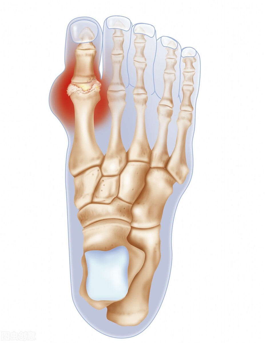 有痛风的患者脚面疼怎么回事,有痛风脚底疼