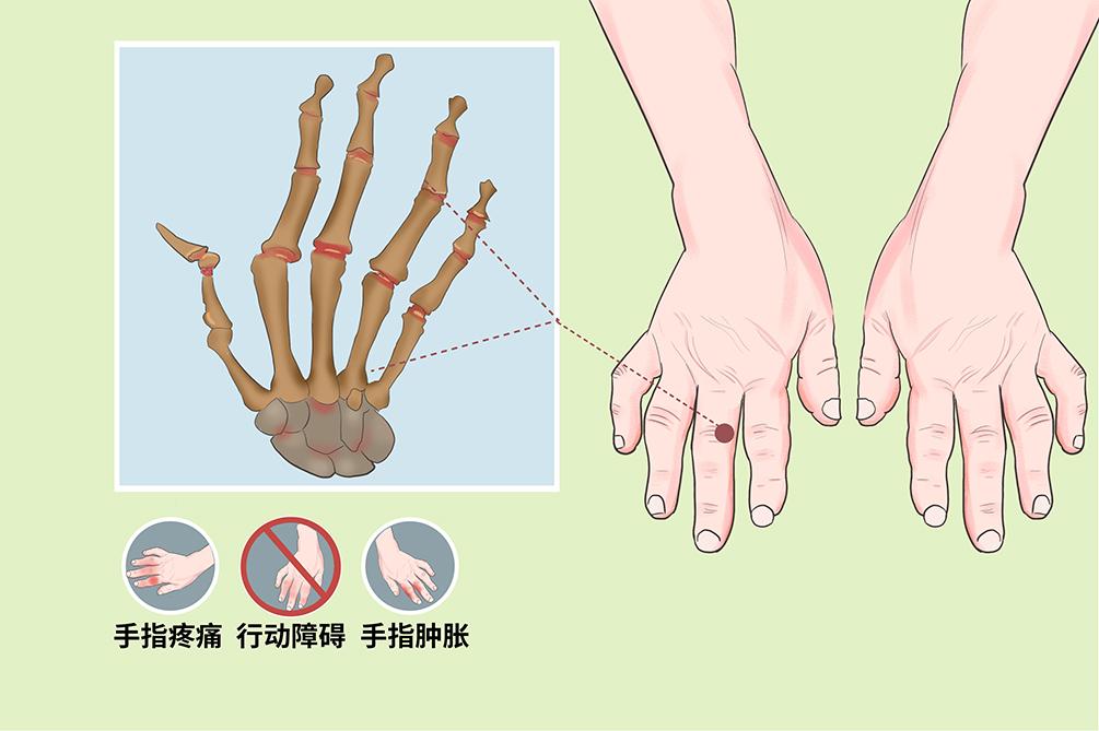 发现手指关节疼是什么原因引起的,手指关节痛是什么原因怎么办呢