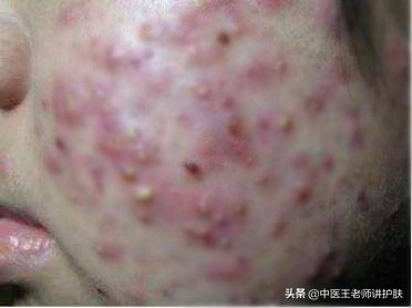 脓包型痘痘的治疗小偏方,治疗痘痘及脓疮最好的偏方