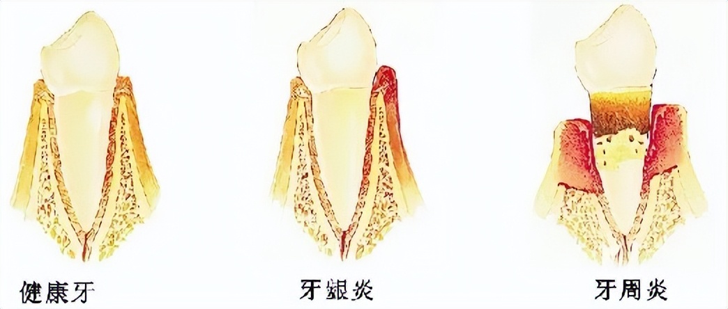 电动牙刷推荐欧乐毕,电动牙刷飞利浦和欧乐b哪个好用