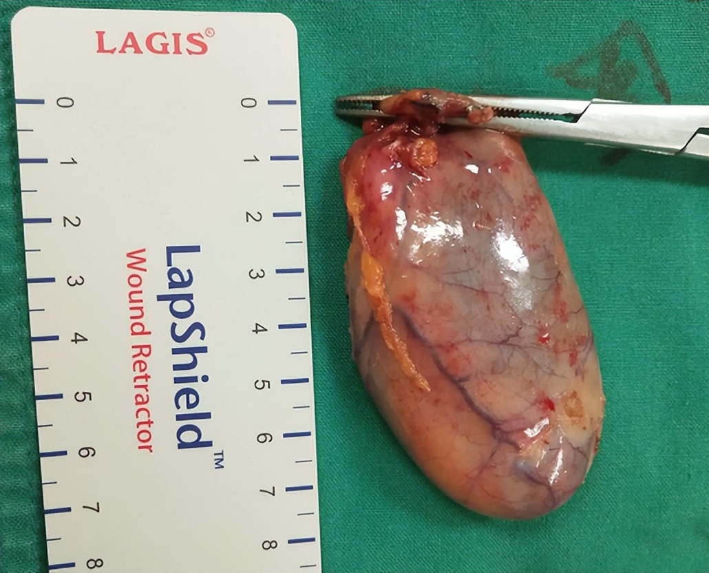 胆囊出现问题身体会出现哪些症状,人没了胆会有哪些症状