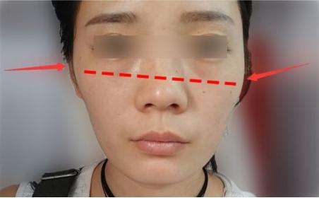 颧骨突出外扩图片,左侧颧骨外扩凸出