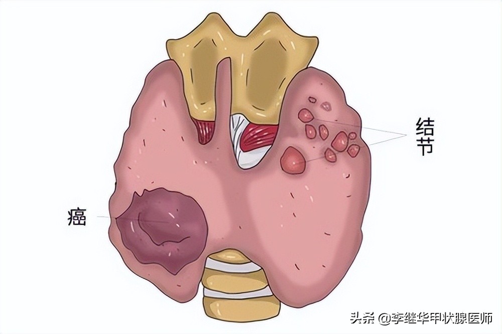 一旦发现有甲状腺结节就要手术吗,请问医生甲状腺结节是不是亚甲炎